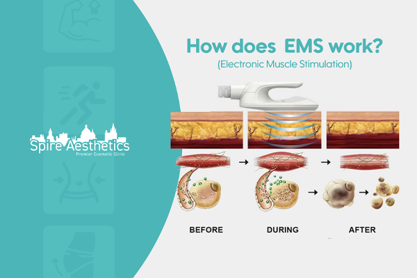 EMS treatment for post pregnancy weight loss treatment Middleton Park