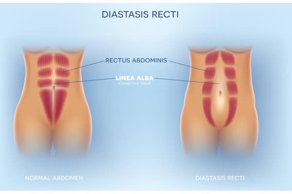 What Non-Surgical Options Are Available for Diastasis Recti Middleton Park?