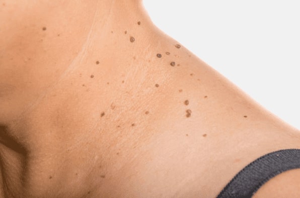 Are you looking for easy skin tag removal Middleton Park - then contact Spire today!