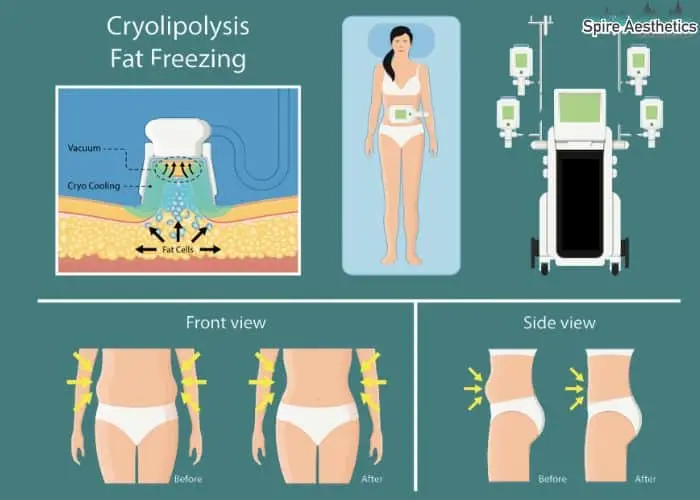 Fat freezing treatment Middleton Park benefits for competitions to remove stubborn fat deposits.