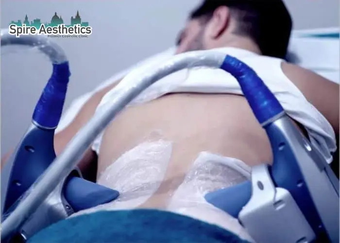 Man having fat freezing treatment done on love handles before a competitions Middleton Park to create a sculpted look.