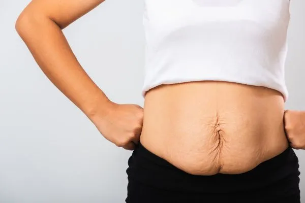 Image of a woman's stomach after weight loss with sagging skin following a gastric band Middleton Park