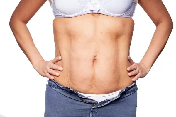 sagging skin on woman's stomach after weight loss injections Middleton Park