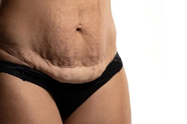 Image of womans stomach after weight loss injections Middleton Park showing saggy skin
