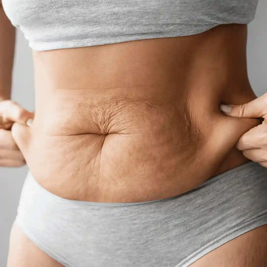 Is It Normal to Have Loose Skin After Pregnancy Middleton Park?